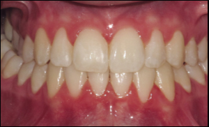 Port Hope Dental - Crowns